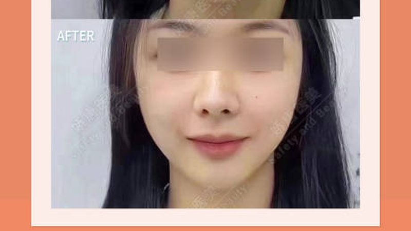 肉毒素注射后洗脸禁忌揭秘