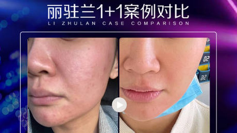 热玛吉五代VS四代：揭秘差异，选对划算