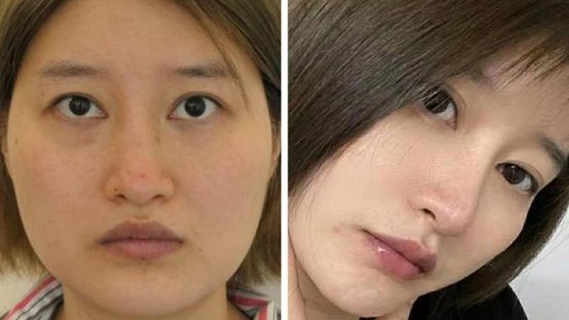 轻医美项目：男士的美丽新选择