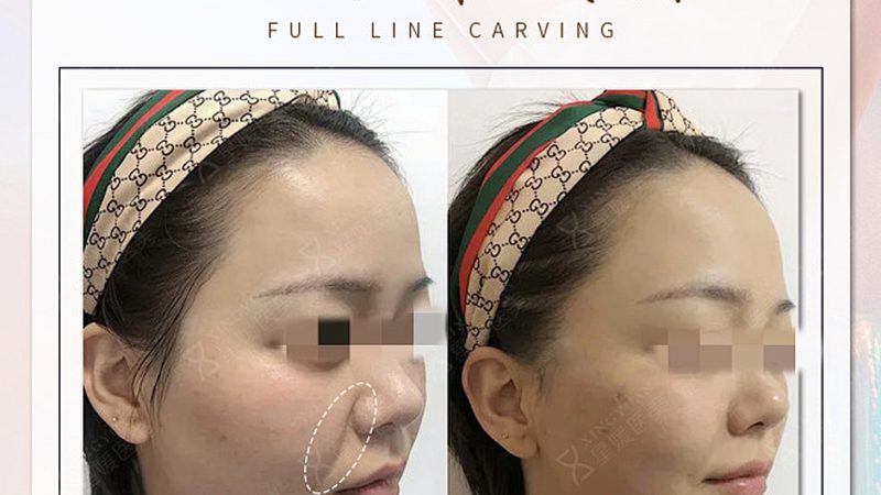 埋线提升恢复期：揭秘术后恢复的秘密