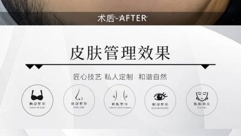 北京下颌角截骨哪家医院好