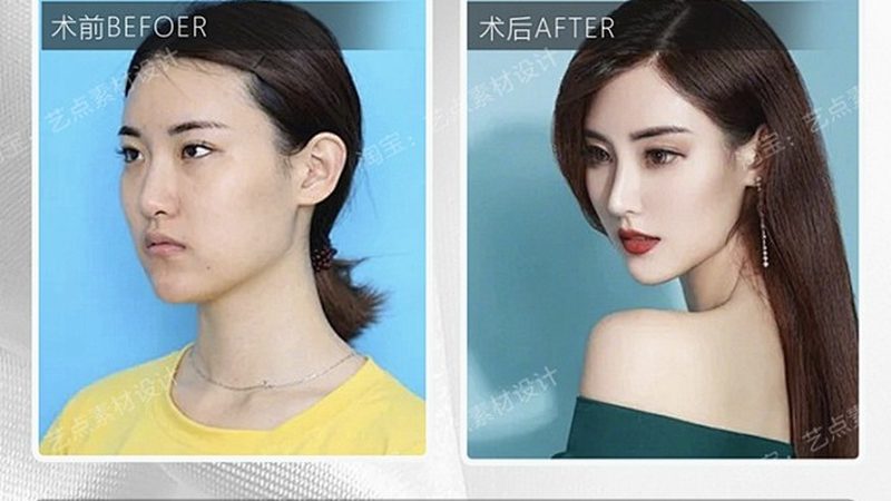 韩式三点双眼皮，揭秘价格背后的秘密**