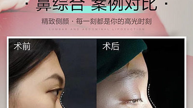 埋线提升与线雕：揭秘两种面部年轻化技术的差异