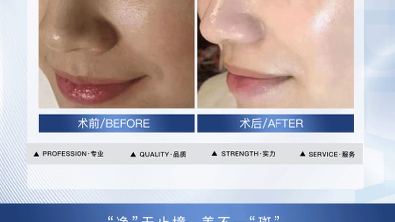 抽脂手术，价格几何？揭秘影响价格的关键因素**