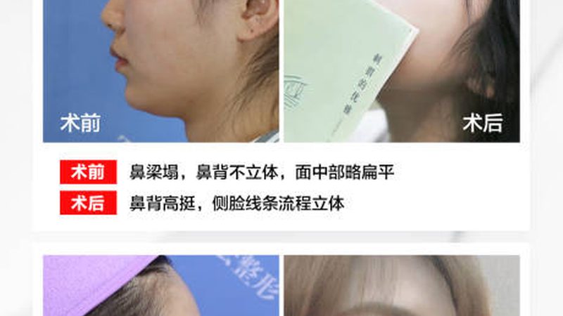 面部注射美容，效果维持时间揭秘