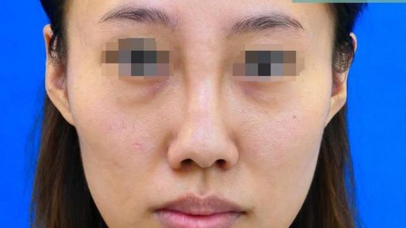 光子嫩肤：揭秘操作流程与价格构成